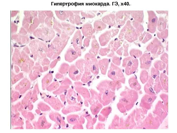 Гипертрофия миокарда. ГЭ, х40. 