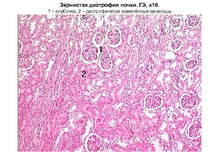 Зернистая дистрофия