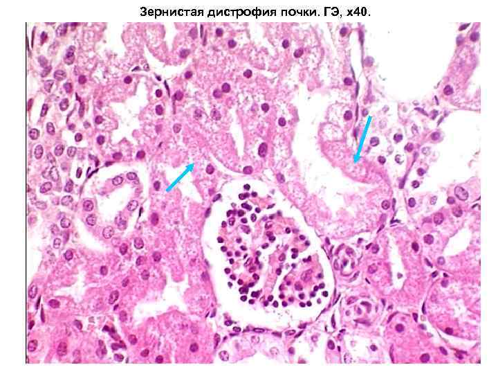 Зернистая дистрофия почки. ГЭ, х40. 