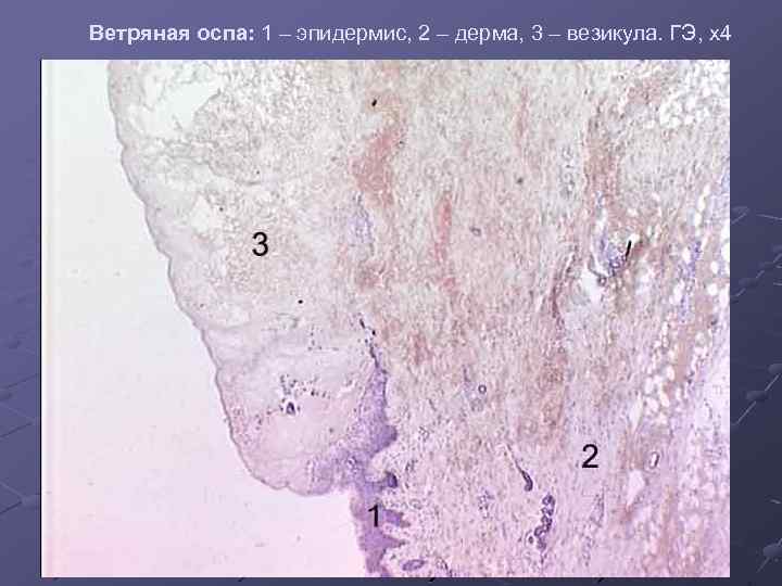 Ветряная оспа: 1 – эпидермис, 2 – дерма, 3 – везикула. ГЭ, х4 