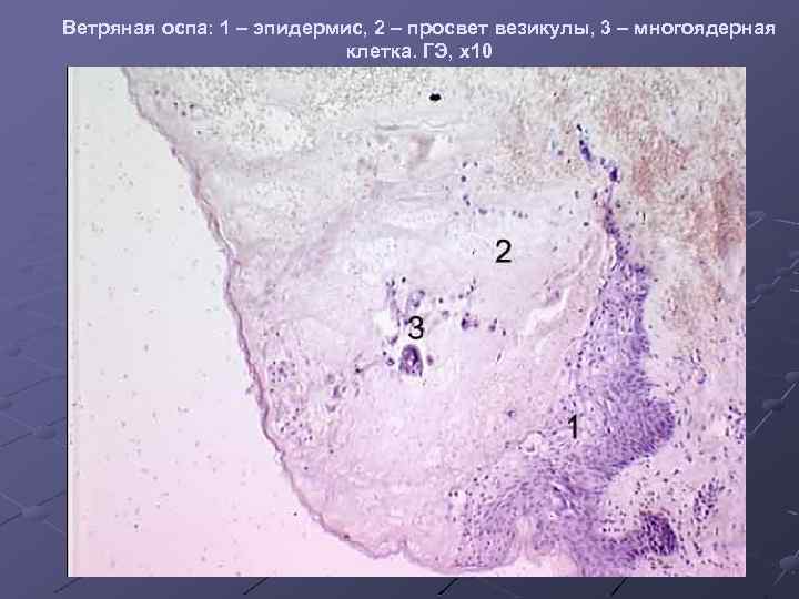 Ветряная оспа: 1 – эпидермис, 2 – просвет везикулы, 3 – многоядерная клетка. ГЭ,