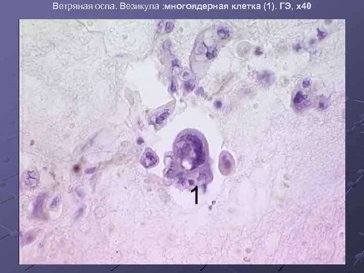 Ветряная оспа. Везикула : многоядерная клетка (1). ГЭ, х40 