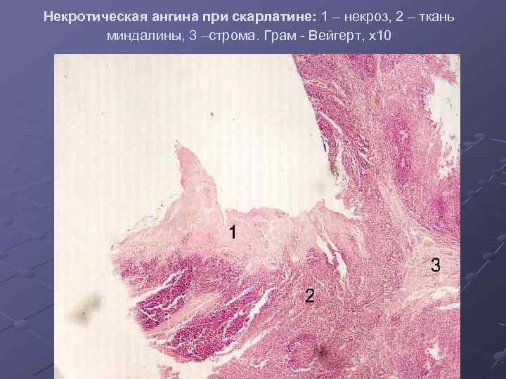 Некротическая ангина при скарлатине: 1 – некроз, 2 – ткань миндалины, 3 –строма. Грам