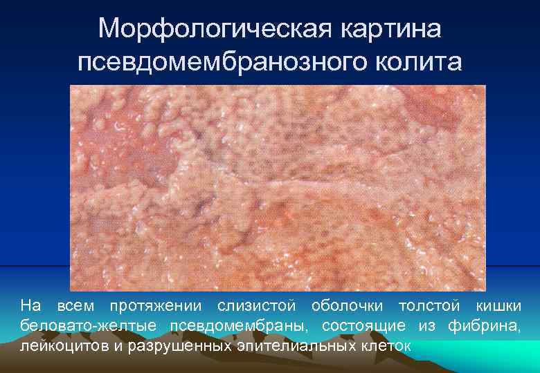 Морфологическая картина псевдомембранозного колита На всем протяжении слизистой оболочки толстой кишки беловато-желтые псевдомембраны, состоящие