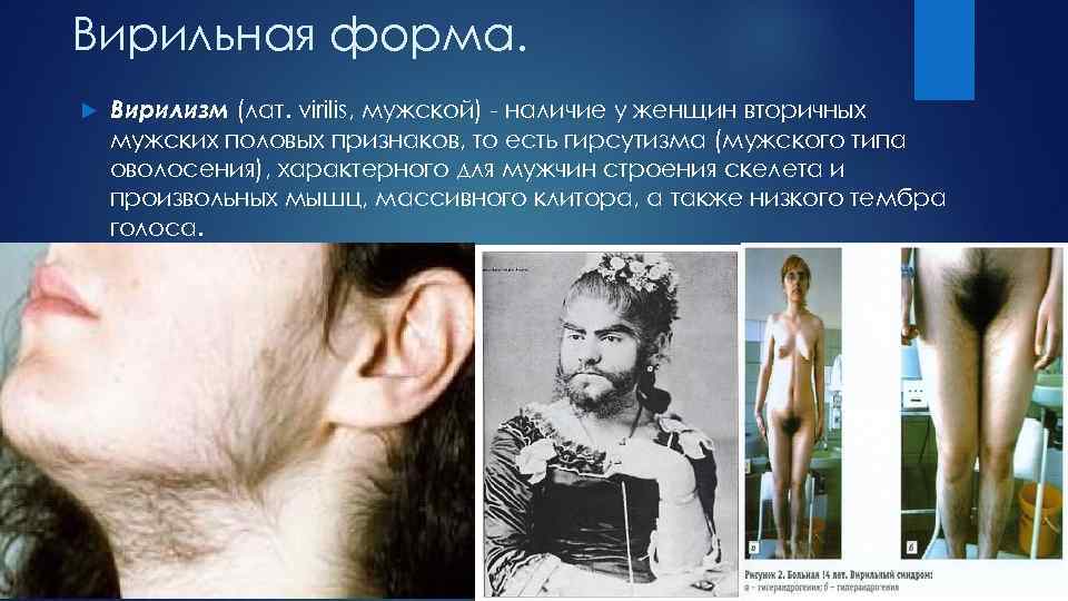 Вирильная форма. Вирилизм (лат. virilis, мужской) наличие у женщин вторичных мужских половых признаков, то