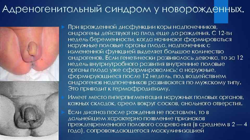 Адреногенитальный синдром у новорожденных. При врожденной дисфункции коры надпочечников, андрогены действуют на плод еще