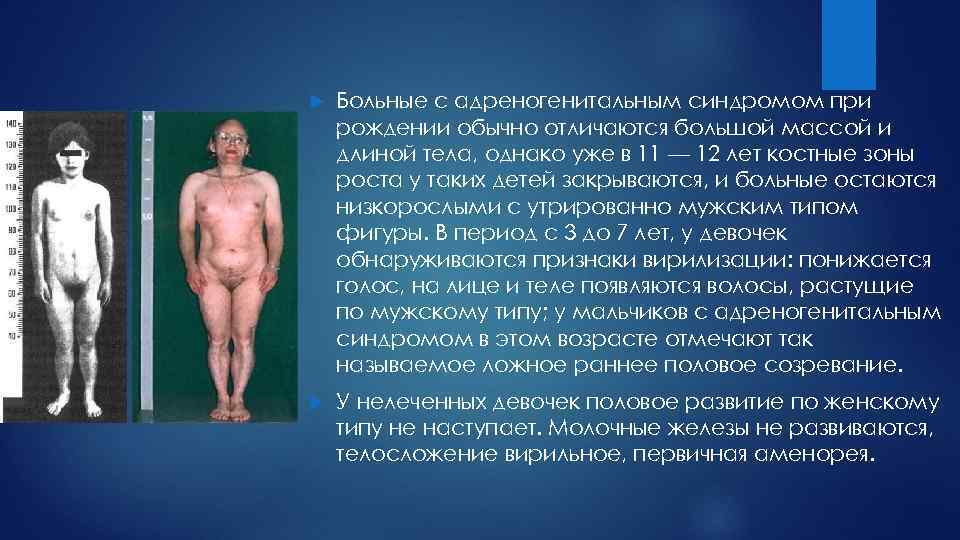  Больные с адреногенитальным синдромом при рождении обычно отличаются большой массой и длиной тела,