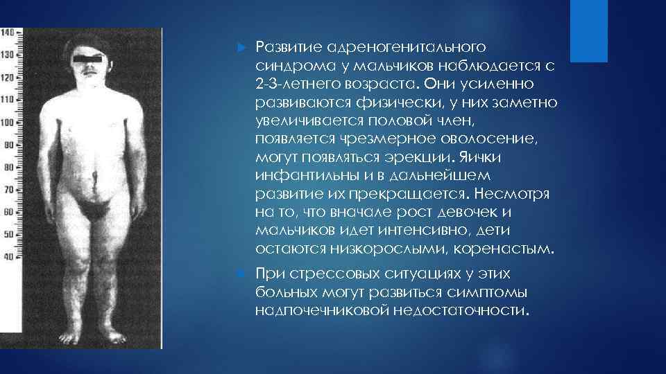  Развитие адреногенитального синдрома у мальчиков наблюдается с 2 3 летнего возраста. Они усиленно