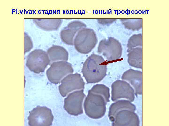 Pl. vivax стадия кольца – юный трофозоит 