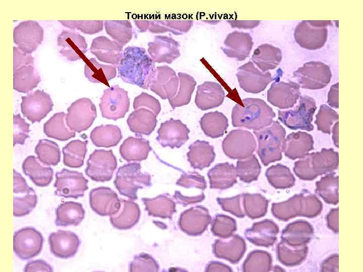 Тонкий мазок (P. vivax) 