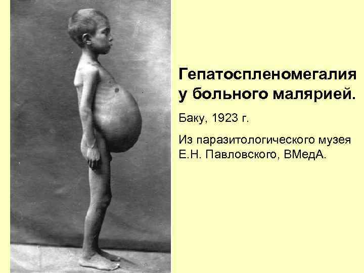 Гепатоспленомегалия у больного малярией. Баку, 1923 г. Из паразитологического музея Е. Н. Павловского, ВМед.