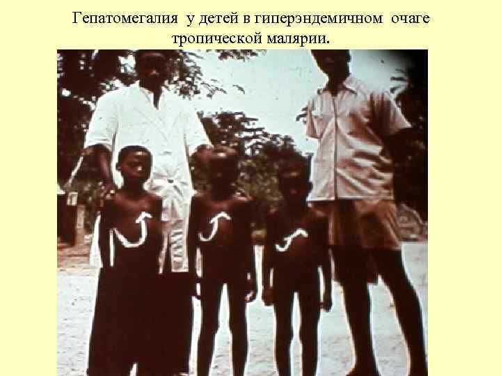 Гепатомегалия у детей в гиперэндемичном очаге тропической малярии. 