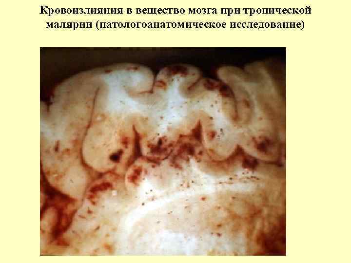 Кровоизлияния в вещество мозга при тропической малярии (патологоанатомическое исследование) 