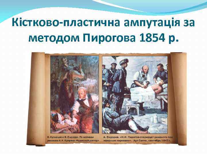 Кістково-пластична ампутація за методом Пирогова 1854 р. 