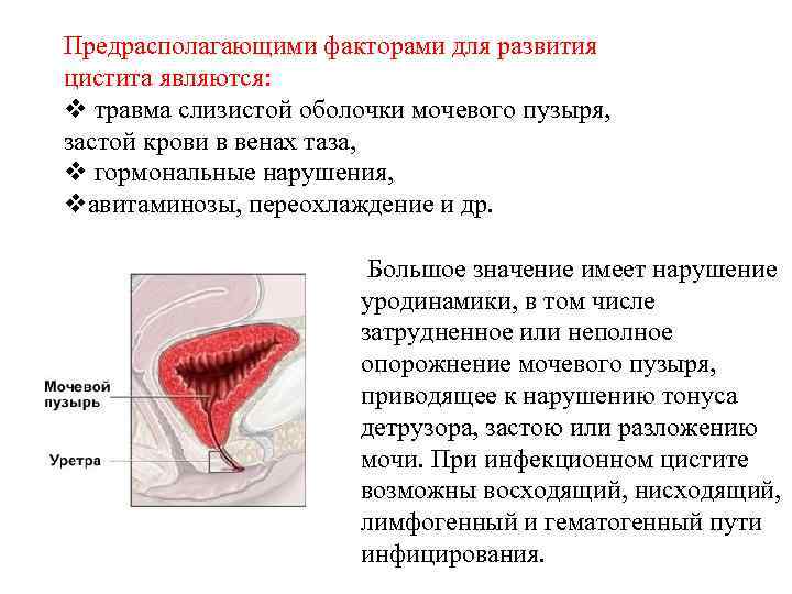 Предрасполагающими факторами для развития цистита являются: v травма слизистой оболочки мочевого пузыря, застой крови
