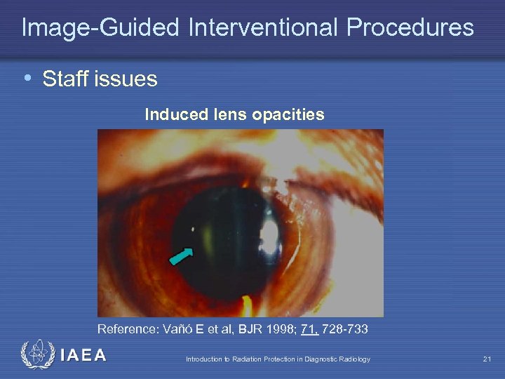 Image-Guided Interventional Procedures • Staff issues Induced lens opacities Reference: Vañó E et al,