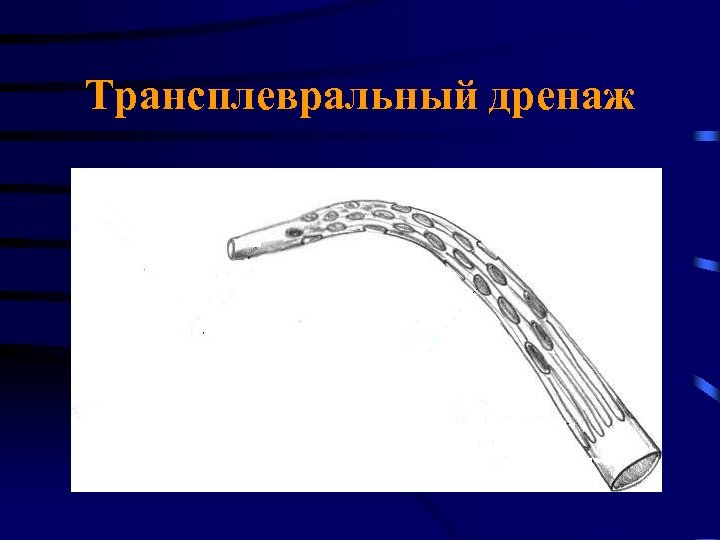 Трансплевральный дренаж 