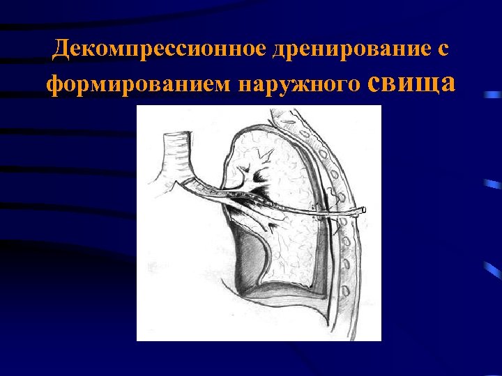 Декомпрессионное дренирование с формированием наружного свища 