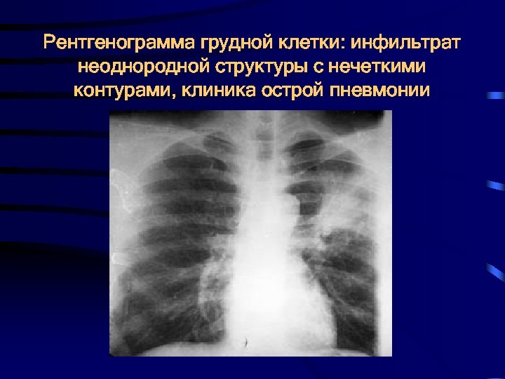 Рентгенограмма грудной клетки: инфильтрат неоднородной структуры с нечеткими контурами, клиника острой пневмонии 