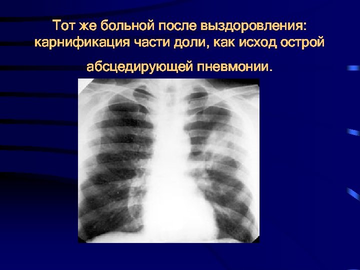 Тот же больной после выздоровления: карнификация части доли, как исход острой абсцедирующей пневмонии. 