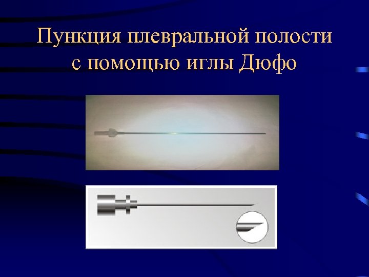 Пункция плевральной полости с помощью иглы Дюфо 