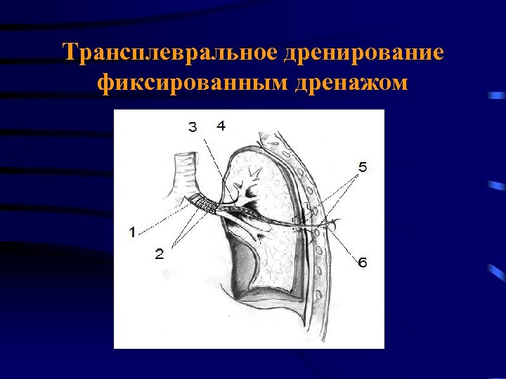 Трансплевральное дренирование фиксированным дренажом 