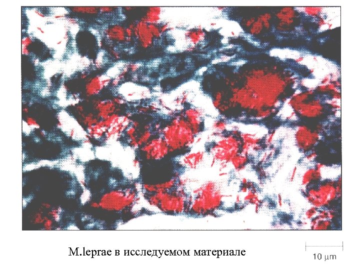 M. leprae в исследуемом материале 