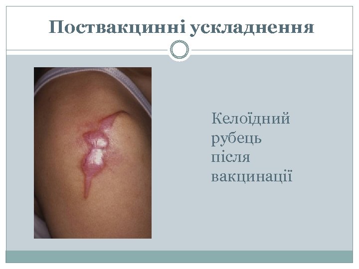  Поствакцинні ускладнення Келоїдний рубець після вакцинації 