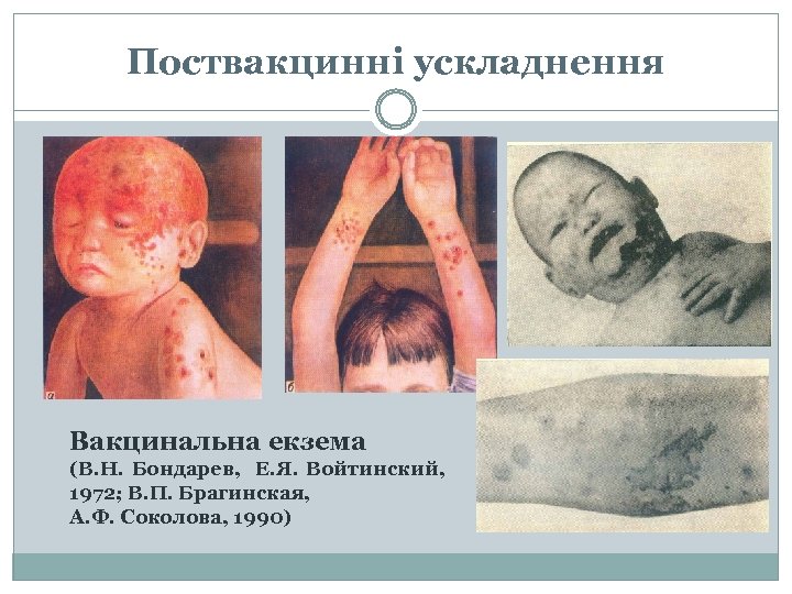 Поствакцинні ускладнення Вакцинальна екзема (В. Н. Бондарев, Е. Я. Войтинский, 1972; В. П. Брагинская,