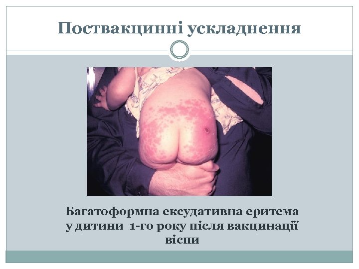 Поствакцинні ускладнення Багатоформна ексудативна еритема у дитини 1 -го року після вакцинації віспи 