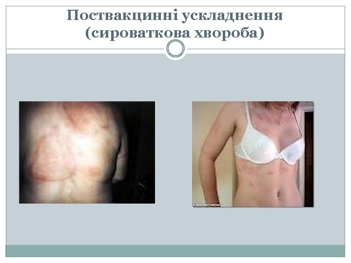 Поствакцинні ускладнення (сироваткова хвороба) 