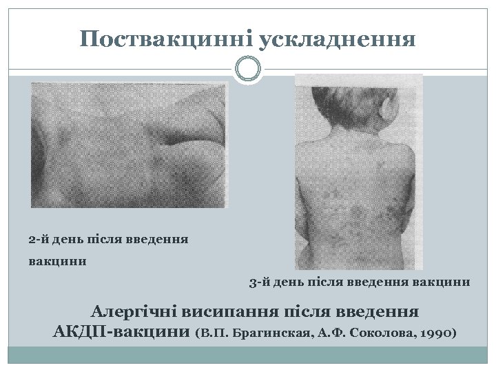 Поствакцинні ускладнення 2 -й день після введення вакцини 3 -й день після введення вакцини