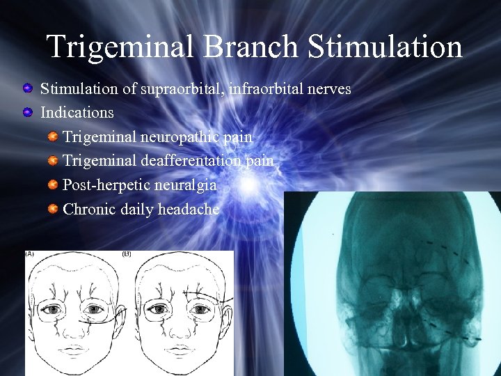 Trigeminal Branch Stimulation of supraorbital, infraorbital nerves Indications Trigeminal neuropathic pain Trigeminal deafferentation pain