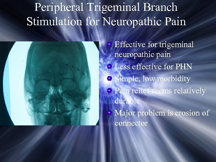 Peripheral Trigeminal Branch Stimulation for Neuropathic Pain Effective for trigeminal neuropathic pain Less effective