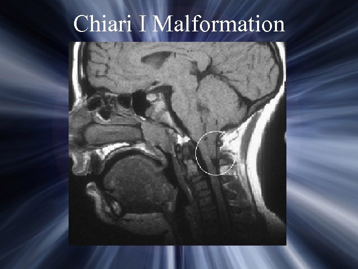 Chiari I Malformation 