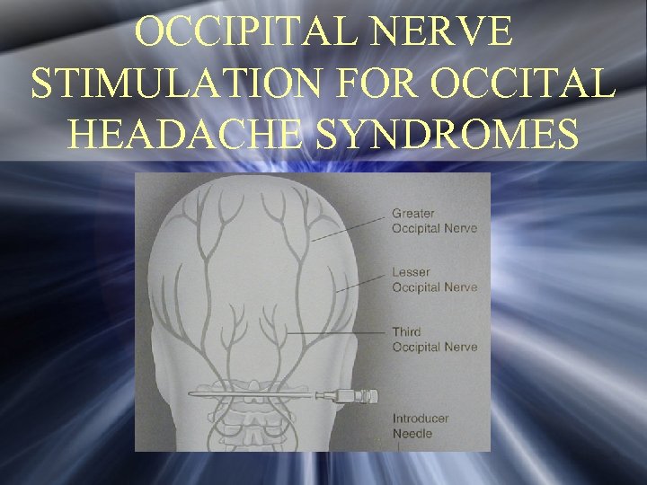 OCCIPITAL NERVE STIMULATION FOR OCCITAL HEADACHE SYNDROMES 