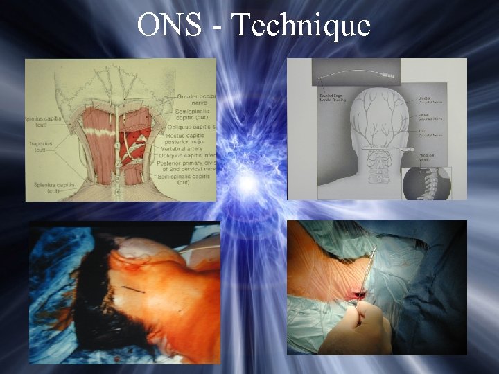 ONS - Technique 