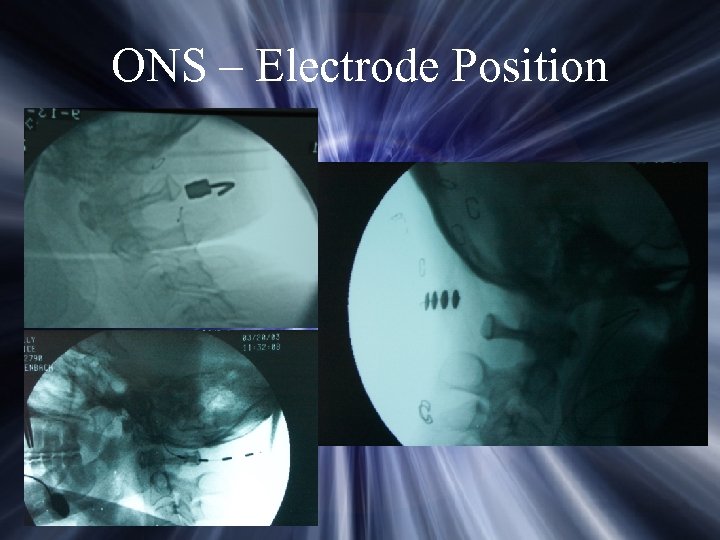 ONS – Electrode Position 