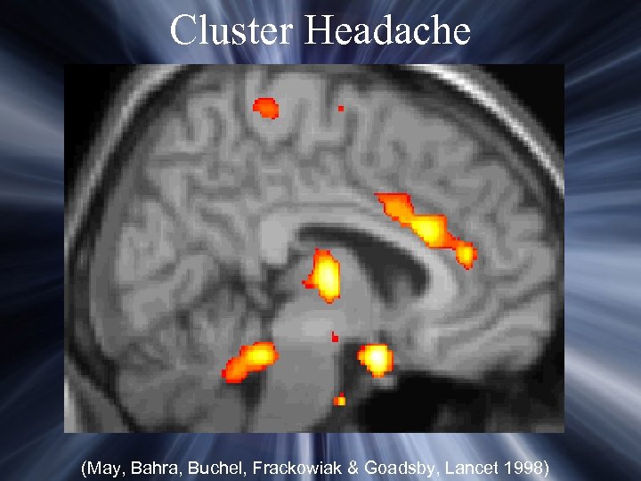 Cluster Headache (May, Bahra, Buchel, Frackowiak & Goadsby, Lancet 1998) 