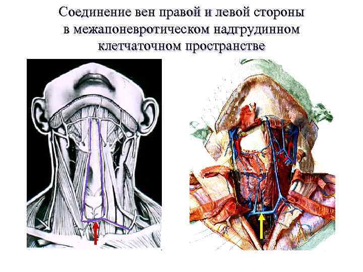 Соединение вен правой и левой стороны в межапоневротическом надгрудинном клетчаточном пространстве Яремная дуга 