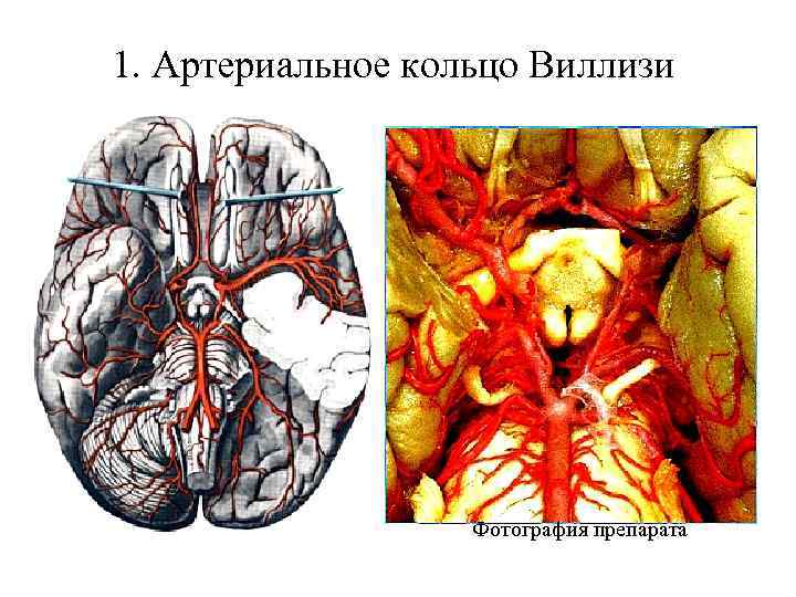 1. Артериальное кольцо Виллизи Фотография препарата 