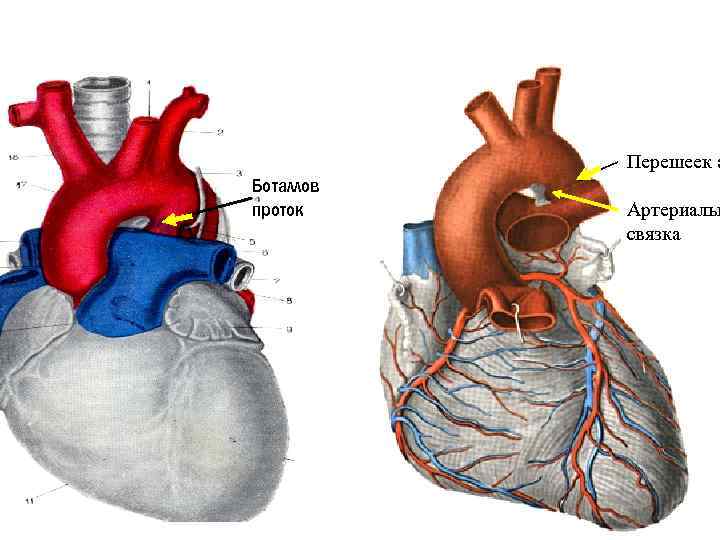 Перешеек а Боталлов проток Артериальн связка 