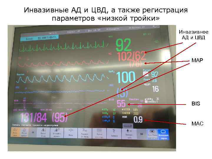 Инвазивные АД и ЦВД, а также регистрация параметров «низкой тройки» Инвазивное АД и ЦВД