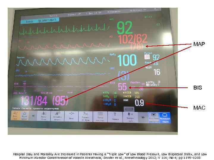 MAP BIS MAC Hospital Stay and Mortality Are Increased in Patients Having a “Triple