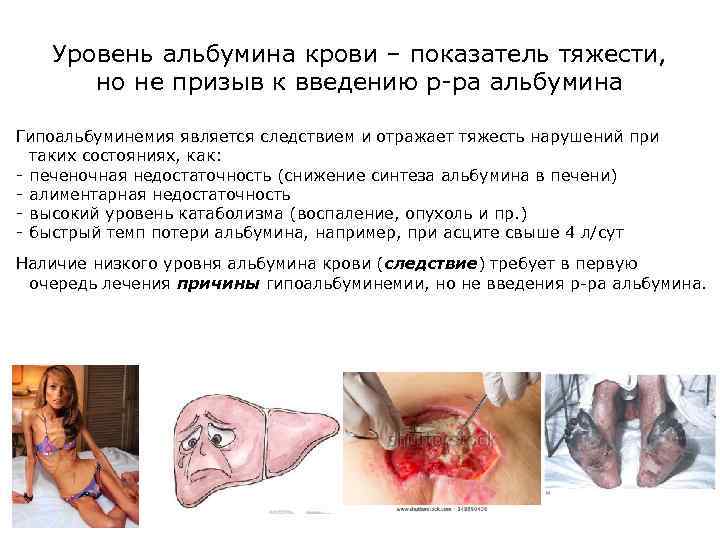 Уровень альбумина крови – показатель тяжести, но не призыв к введению р-ра альбумина Гипоальбуминемия