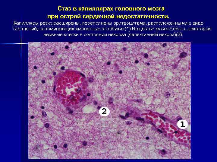Стаз в капиллярах головного мозга при острой сердечной недостаточности. Капилляры резко расширены, переполнены эритроцитами,