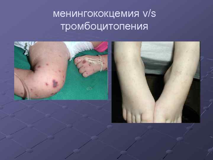 менингококцемия v/s тромбоцитопения 