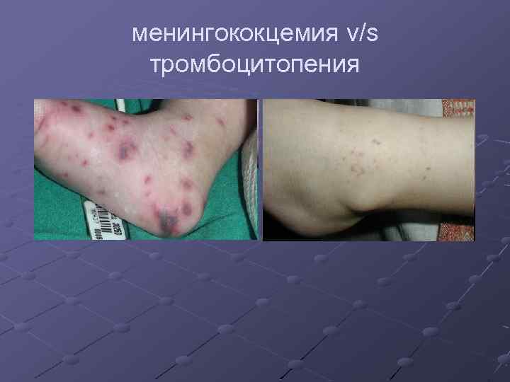 менингококцемия v/s тромбоцитопения 