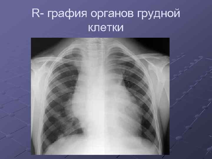 R- графия органов грудной клетки 