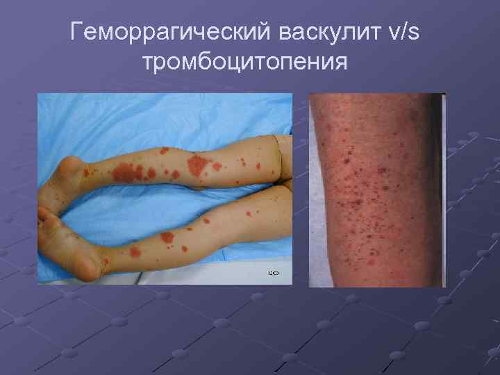 Геморрагический васкулит v/s тромбоцитопения 